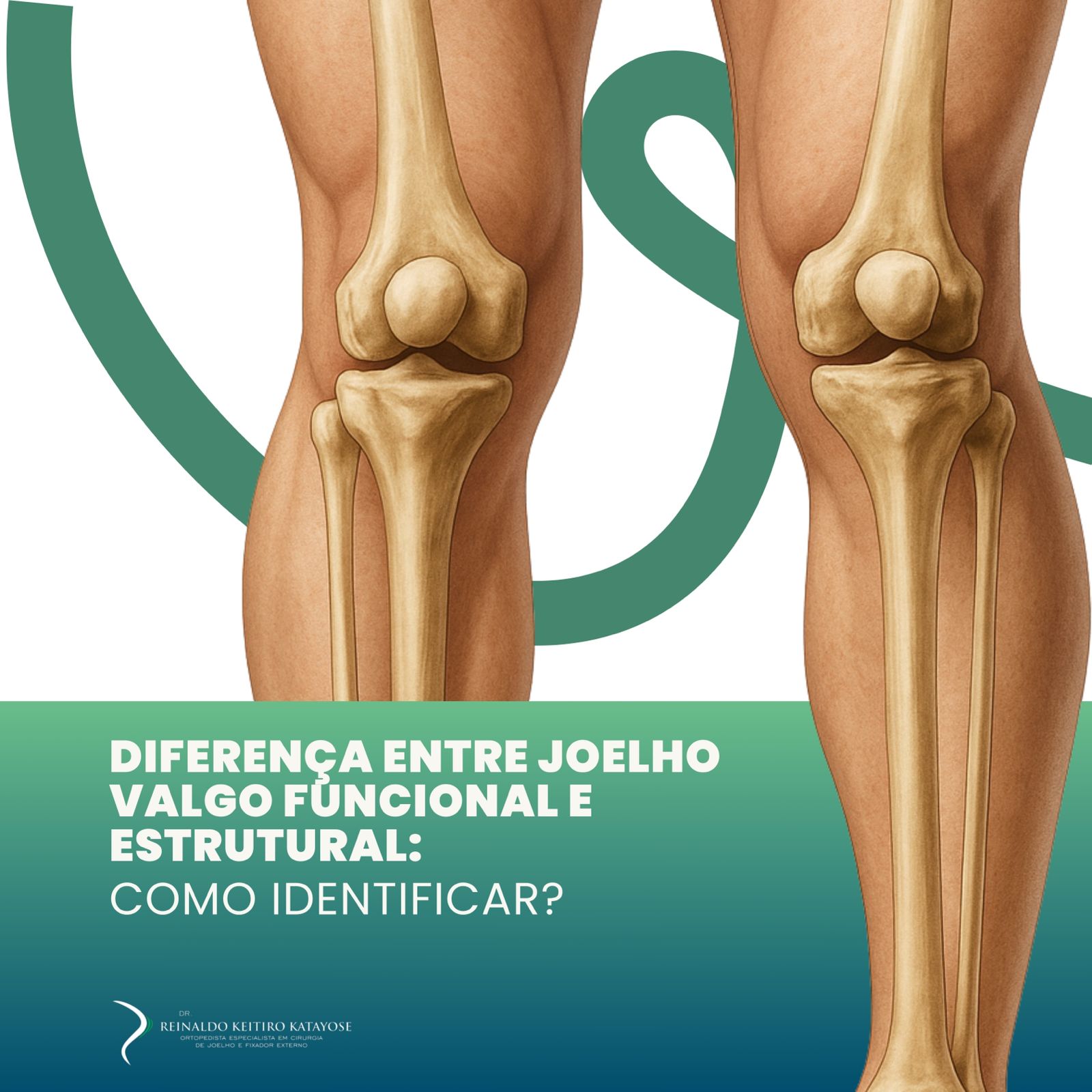 Diferença entre joelho valgo funcional e estrutural: como identificar?